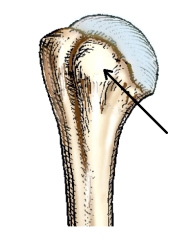 <strong>The small,rounded,elevated process identified by the arrow in this figure is the: </strong> A) acromion. B) anatomic neck. C) greater tubercle. D) lesser tubercle.