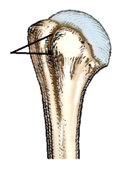 <strong>The depression identified in this figure is called the: </strong> A) infraspinous fossa. B) supraspinous fossa. C) intertubercular groove. D) surgical neck.