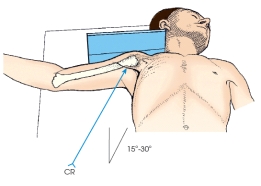 <strong>The projection of the shoulder demonstrated in this figure is the: </strong> A) axiolateral. B) inferosuperior axial (Lawrence). C) transthoracic lateral (Lawrence). D) acromioclavicular (Pearson).