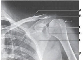 <strong>The projection in the image below was obtained with the arm positioned in: </strong> A) neutral position. B) external rotation. C) internal rotation. D) oblique rotation.