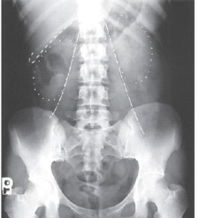 <strong>Which structures are outlined with dots in this AP image of the abdomen?  </strong> A) Stomach B) Liver C) Kidneys D) Psoas muscles <div style=padding-top: 35px> 