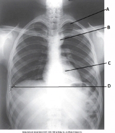 <strong>What anatomy is labeled as letter D and outlined with white dots in the image below?  </strong> A) Apex of right lung B) Apex of left lung C) Costophrenic angle of right lung D) Costophrenic angle of left lung <div style=padding-top: 35px> 