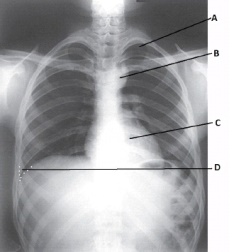 <strong>What anatomy is labeled as letter B in the image below?  </strong> A) Apex of right lung B) Apex of left lung C) Aortic arch D) Thymus gland <div style=padding-top: 35px> 