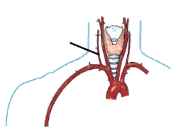 <strong>The artery identified in the figure below is the: </strong> A) left vertebral. B) right vertebral. C) right common carotid. D) left internal carotid.