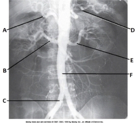 <strong>Letter B in the abdominal aortogram image below is the _____ artery. </strong> A) splenic B) celiac C) R renal D) hepatic