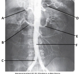 <strong>Letter D in the abdominal aortogram image below is the _____ artery. </strong> A) hepatic B) splenic C) L renal D) superior mesenteric