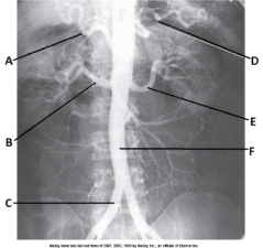 <strong>Letter E in the abdominal aortogram image below is the _____ artery. </strong> A) hepatic B) splenic C) L renal D) superior mesenteric