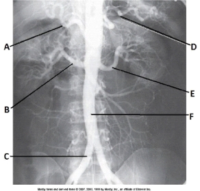 <strong>Letter F in the abdominal aortogram image below is the: </strong> A) abdominal aorta. B) common iliac artery. C) superior mesenteric artery. D) inferior mesenteric artery.
