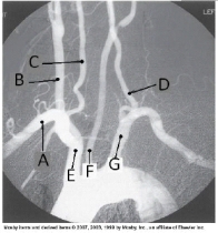 <strong>Letter C in the angiographic image of the aortic arch and its branches below is the _____ artery. </strong> A) innominate (brachiocephalic) B) R common carotid C) R subclavian D) R vertebral