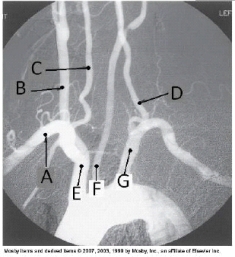 <strong>Letter D in the angiographic image of the aortic arch and its branches below is the _____ artery. </strong> A) innominate (brachiocephalic) B) L common carotid C) L subclavian D) L vertebral