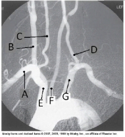 <strong>Letter G in the angiographic image of the aortic arch and its branches below is the _____ artery. </strong> A) innominate (brachiocephalic) B) L common carotid C) L subclavian D) L vertebral