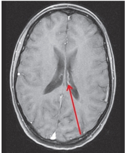 <strong>The red arrow is pointing to the bright structure within the dark gray structure.What anatomy is indicated by the arrow? </strong> A) Septum pallucidum B) Corpus callosum C) Caudate nucleus D) Choroid plexus