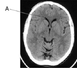 <strong>Line A is pointing to the _____ in this CT image of the brain. </strong> A) choroid plexus B) third ventricle C) lateral ventricle,anterior horn D) lateral ventricle,occipital horn