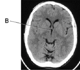 <strong>Line B is pointing to the _____ in this CT image of the brain. </strong> A) pituitary gland B) third ventricle C) lateral ventricle D) foramen of Monroe