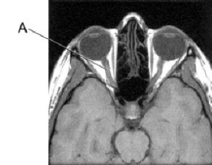 <strong>Line A is pointing to the: </strong> A) optic nerve. B) pituitary gland. C) carotid artery. D) carotid vein.