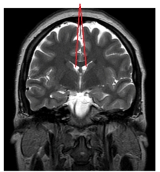 <strong>The lines in this image point to the: </strong> A) pons. B) third ventricle. C) cerebellum. D) lateral ventricles.