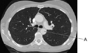 <strong>In this cross section of the thorax,line A identifies the: </strong> A) bronchus. B) esophagus. C) ascending aorta. D) descending aorta.