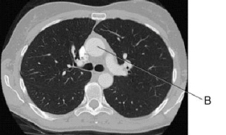 <strong>In this cross section of the thorax,line B identifies the: </strong> A) bronchus. B) esophagus. C) ascending aorta. D) descending aorta.