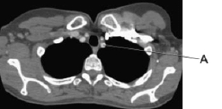 <strong>Line A in this axial CT scan identifies the left: </strong> A) clavicle. B) brachiocephalic vein. C) subclavian artery. D) subclavian vein.