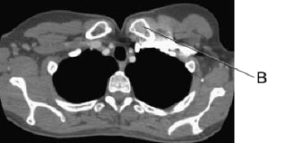 <strong>Line B in this axial CT scan identifies the left: </strong> A) clavicle. B) brachiocephalic vein. C) subclavian artery. D) subclavian vein.