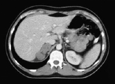 <strong>This image is a(n)_____ plane of the _____ abdomen. </strong> A) axial; upper B) coronal; upper C) axial; lower D) coronal; lower