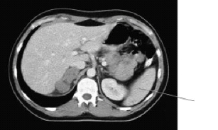 <strong>The line on this image is pointing to the: </strong> A) colon. B) kidney. C) stomach. D) spleen.
