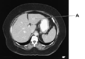 <strong>Line A on this image is pointing to the: </strong> A) right lobe of the liver. B) left lobe of the liver. C) caudate lobe of the liver. D) falciform ligament.