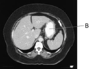 <strong>Line B on this image is pointing to the: </strong> A) liver. B) stomach. C) spleen. D) small bowel.