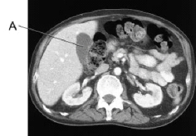 <strong>Line A on this image is pointing to the: </strong> A) liver. B) spleen. C) L kidney. D) gallbladder.
