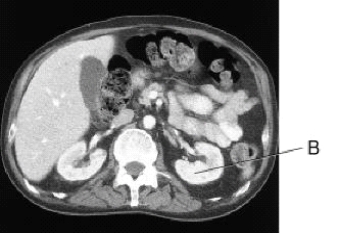<strong>Line B on this image is pointing to the: </strong> A) liver. B) spleen. C) L kidney. D) gallbladder.