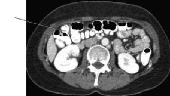 <strong>The line on this CT scan is pointing to the: </strong> A) liver. B) sternum. C) stomach. D) transverse colon.