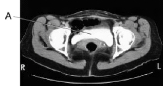 <strong>Line A on this CT scan is pointing to the: </strong> A) uterus. B) rectum. C) bladder. D) small bowel.