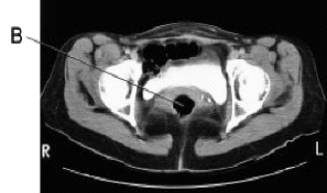 <strong>Line B on this CT scan is pointing to the: </strong> A) uterus. B) rectum. C) bladder. D) small bowel.