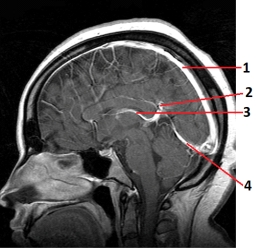 <strong>Which number labels the straight sinus in this image? </strong> A) 1 B) 2 C) 3 D) 4
