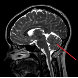 <strong>The line on the image below points to the: </strong> A) occipital lobe. B) temporal lobe. C) pons. D) cerebellum.