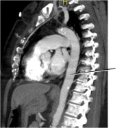 <strong>On the image below,the line points to the: </strong> A) spinal cord. B) ascending aorta. C) descending aorta. D) abdominal aorta.