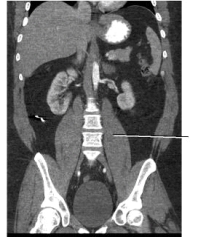 <strong>Examine the image below.The line points to the _____ muscle. </strong> A) left psoas B) right psoas C) rectus abdominis D) external oblique