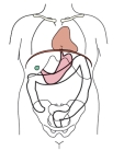 <strong>Which body habitus is shown in this figure? </strong> A) Hypersthenic B) Hyposthenic C) Asthenic D) Atrophic