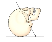 <strong>The x-ray projection identified in this figure is: </strong> A) AP. B) PA. C) AP axial. D) AP oblique.