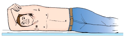 <strong>What is the patient position illustrated in this figure? </strong> A) Dorsal recumbent B) Right lateral recumbent C) Left lateral decubitus D) Trendelenburg