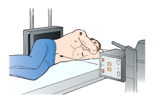 <strong>The x-ray projection shown in this figure is: </strong> A) AP. B) PA. C) right lateral. D) right lateral decubitus.