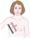 <strong>The projection of the breast shown in the figure below is a:  </strong> A) mediolateral (ML). B) lateromedial (LM). C) mediolateral oblique (MLO). D) lateromedial oblique (LMO). <div style=padding-top: 35px> 