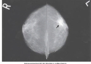 <strong>The arrow in the images below points to a mass with the characteristics of a:  </strong> A) benign tumor. B) malignant tumor. C) fibrous tissue mass. D) cystic lesion. <div style=padding-top: 35px> 
