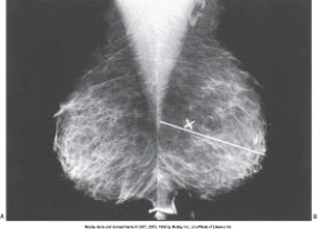 <strong>The white line,labeled as X in the images below is the _____ line.  </strong> A) posterior nipple B) pectoralis muscle C) breast width D) breast length <div style=padding-top: 35px> 