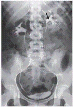 <strong>The dilated,proximal portion of the ureter is labeled with an arrow.What is the name of this anatomy shown in the image from an IVU below? </strong> A) Renal pelvis B) Hilum C) Calyx D) Trigone