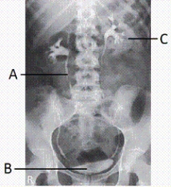 <strong>What anatomy is labeled with the letter A shown in the image from an IVU examination below? </strong> A) Left ureter B) Right ureter C) Left renal pelvis D) Right renal pelvis