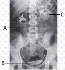 <strong>Letter B shown in the image from an IVU examination below labels the: </strong> A) right renal pelvis. B) right ureter. C) urinary bladder. D) symphysis pubis.