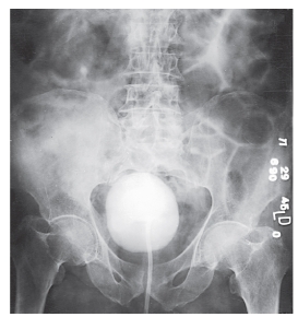 <strong>What is the projection and procedure demonstrated in this image? </strong> A) AP,IVU B) AP,cystogram C) PA,retrogram urogram D) AP oblique,IVU