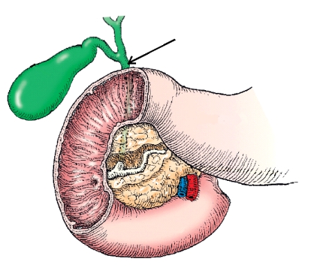 <strong>The anatomy labeled with the arrow in this figure is the: </strong> A) cystic duct. B) common hepatic duct. C) common bile duct. D) pancreatic duct.