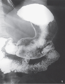 <strong>Which projection of the stomach is demonstrated in this figure? </strong> A) PA B) PA oblique C) AP oblique D) Lateral